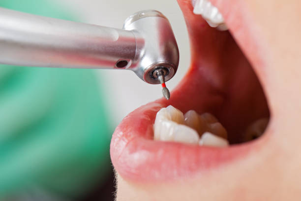 Best Emergency Dentist for Knocked-Out Tooth in Marina Del Rey, CA